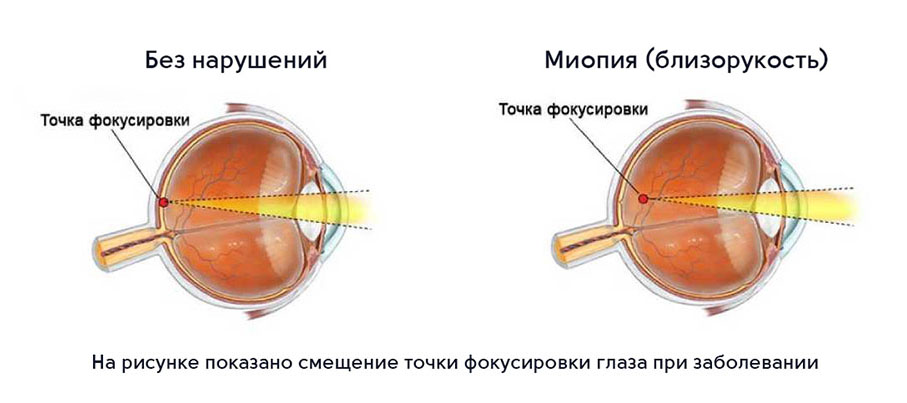 Лечение миопии (близорукости) Лечение миопии (близорукости)
