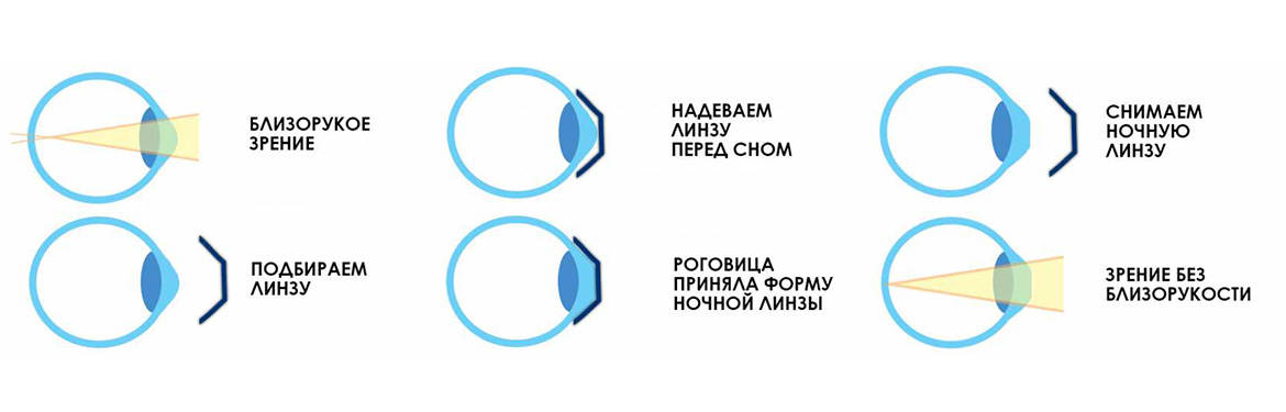 Жесткие ночные контактные линзы (ортокератология) Жесткие ночные контактные линзы (ортокератология)